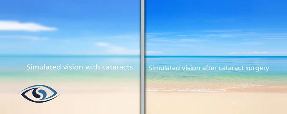 Cataract