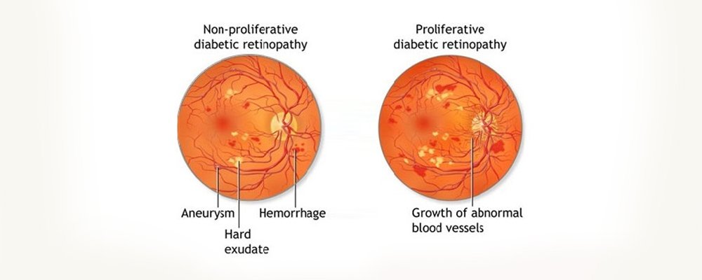 retina