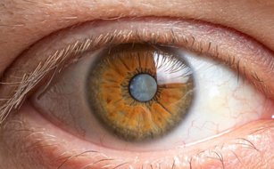 Cataract