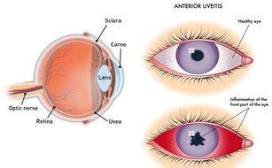 Uveitis